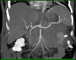 Lymphoma Infiltrates Perirenal Space and Involves the Pancreas - CTisus CT Scan