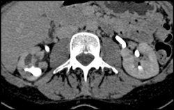 Blunted Calyx - CTisus CT Scan
