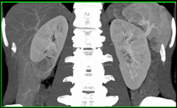 Decreased Enhancement Lower Pole of Right Kidney - CTisus CT Scan