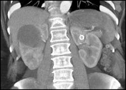 Left Renal Artery Aneurysm - CTisus CT Scan