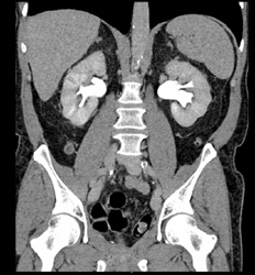 Ileal Loop With CT Urogram - CTisus CT Scan