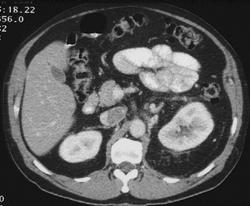 Perinephric Stranding Around Kidney - CTisus CT Scan