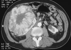Oncocytoma - CTisus CT Scan