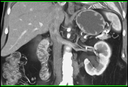 Retroperitoneal Fibrosis With Left Hydronephrosis - CTisus CT Scan