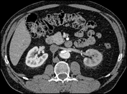 Aortic Dissection With Decreased Function in the Left Kidney - CTisus CT Scan