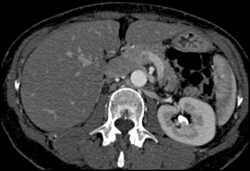 Retroaortic Renal Vein - CTisus CT Scan