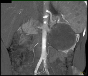Cystic Renal Cell Carcinoma - CTisus CT Scan