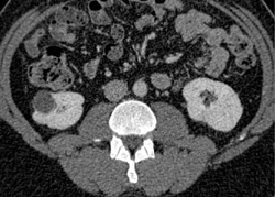 Transitional Cell Carcinoma of the Left Kidney - CTisus CT Scan