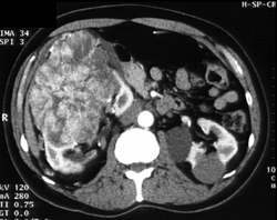 Oncocytoma - CTisus CT Scan