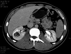 Renal Cell Carcinoma - CTisus CT Scan