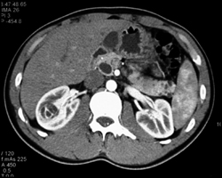 Renal Cell Carcinoma - CTisus CT Scan