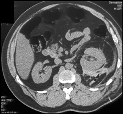 Perirenal Hemorrhage S/P Biopsy - CTisus CT Scan
