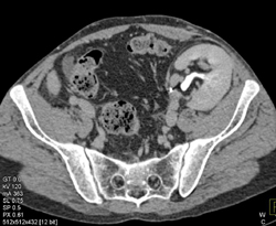 Transplant Kidney With Focal Pyelonephritis - CTisus CT Scan