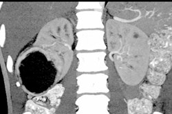 Renal Abscess - CTisus CT Scan