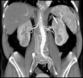Carcinoma of the Right Kidney With Bone Metastases - CTisus CT Scan
