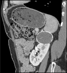 Calcified Renal Cyst - CTisus CT Scan