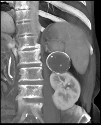 Calcified Renal Cyst - CTisus CT Scan