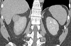 Cystic Renal Cell Carcinoma - CTisus CT Scan