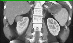 Cystic Renal Cell Carcinoma - CTisus CT Scan