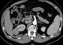 Cystic Renal Cell Carcinoma - CTisus CT Scan
