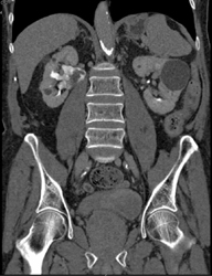 Transitional Cell Carcinoma - CTisus CT Scan