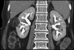 Renal Angiomyolipoma (AML) - CTisus CT Scan