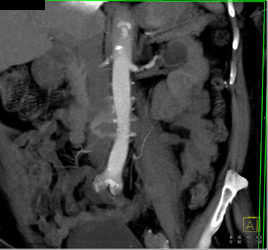 Renal Artery Stenosis - CTisus CT Scan