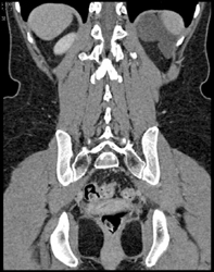 Duplication Cyst in Left Upper Quadrant Near Kidney - CTisus CT Scan
