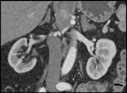 Left Renal Artery Aneurysm - CTisus CT Scan