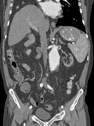 Left Renal Artery Aneurysm - CTisus CT Scan