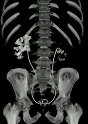 Chronic Pyelonephritis and Acute Pyelo - CTisus CT Scan
