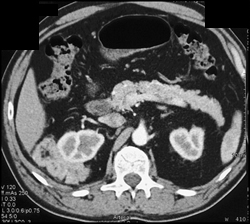Renal Angiomyolipoma (AML) - CTisus CT Scan