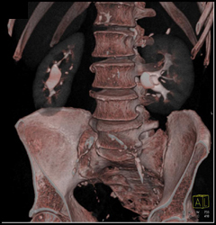 Transitional Cell Carcinoma of the Left Kidney - CTisus CT Scan