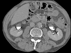 Transitional Cell Carcinoma of the Left Kidney - CTisus CT Scan