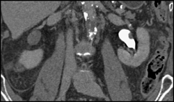 Transitional Cell Carcinoma of the Left Kidney - CTisus CT Scan
