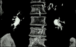 Transitional Cell Carcinoma of the Left Kidney - CTisus CT Scan