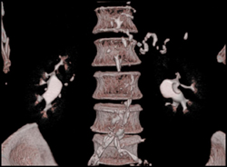 Transitional Cell Carcinoma of the Left Kidney - CTisus CT Scan