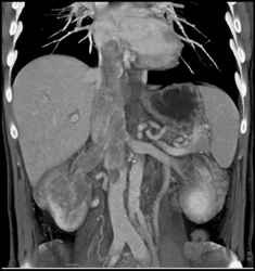 Renal Cell Carcinoma Invades the Inferior Vena Cava (IVC) - CTisus CT Scan