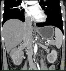 Renal Cell Carcinoma Invades the Inferior Vena Cava (IVC) - CTisus CT Scan