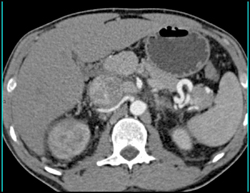 Renal Cell Carcinoma Invades the Inferior Vena Cava (IVC) - CTisus CT Scan