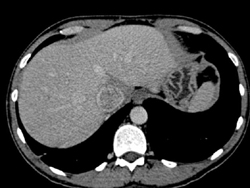 Renal Cell Carcinoma Invades the Inferior Vena Cava (IVC) - CTisus CT Scan