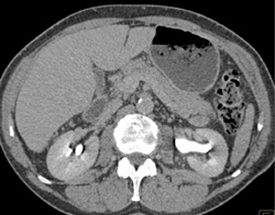 Atypical Cyst in Left Kidney - CTisus CT Scan