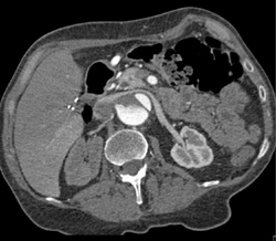 Decreased Right Renal Function Due to Dissection - CTisus CT Scan