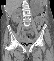 Right Renal Calculus - CTisus CT Scan