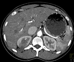 Acute Pyelonephritis - CTisus CT Scan