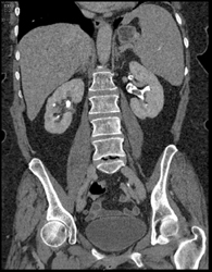 Blood Clots in Left Renal Pelvis - CTisus CT Scan
