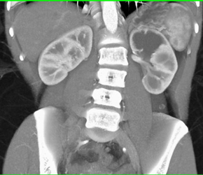 Obstructed Upper Pole Collecting System - CTisus CT Scan