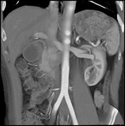 Circumaortic Left Renal Vein - CTisus CT Scan