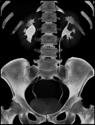 Ct Urogram-dilated Right Renal Pelvis - CTisus CT Scan