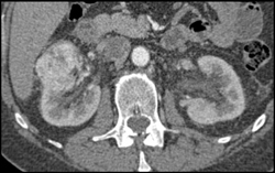 Renal Cell Carcinoma - CTisus CT Scan